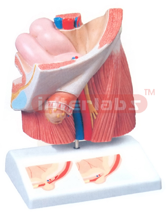 INGUINAL HERNIA